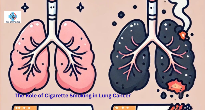 The Role of Cigarette Smoking in Lung Cancer